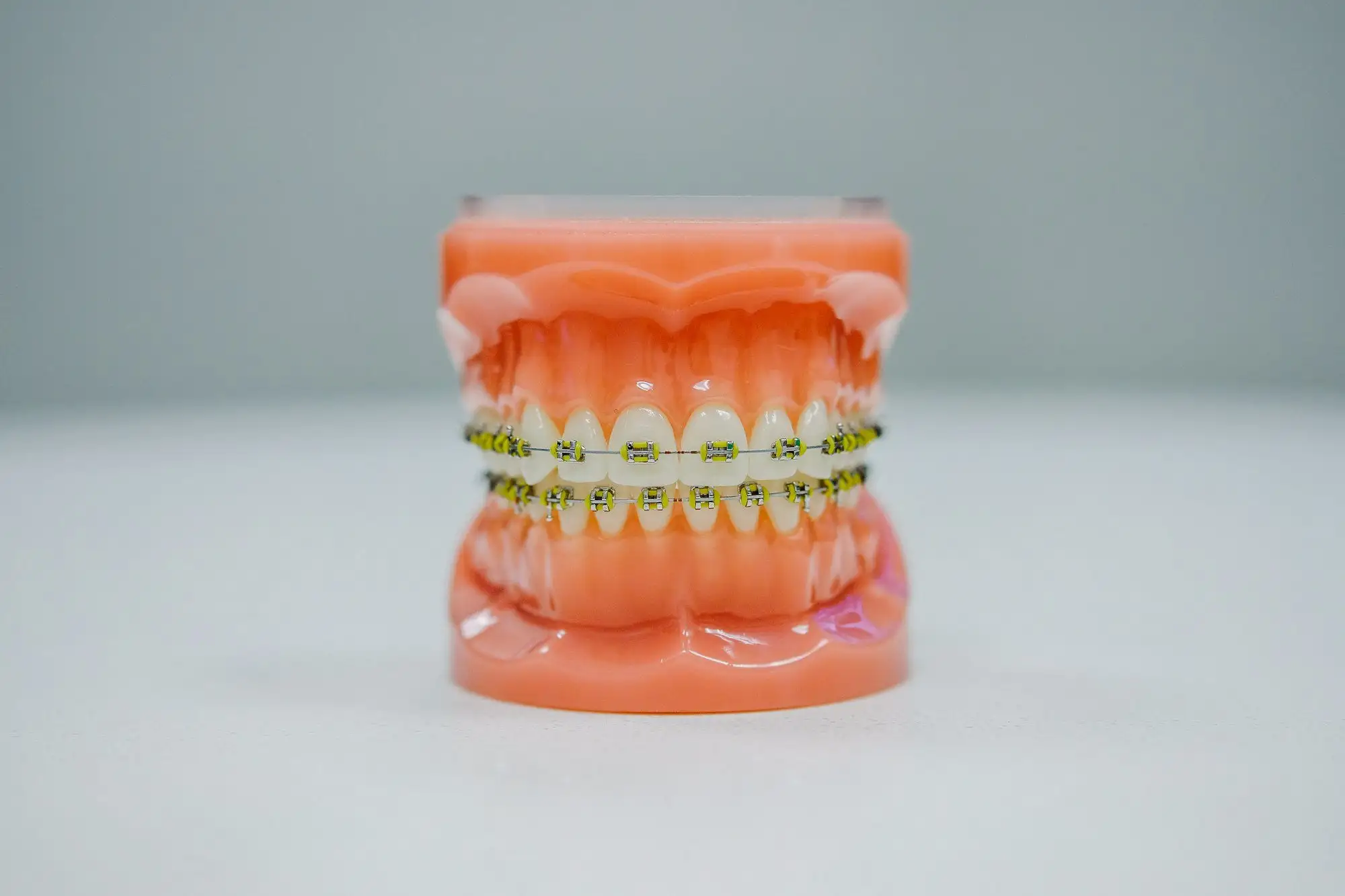 A dental model of upper and lower teeth with braces, on a white surface